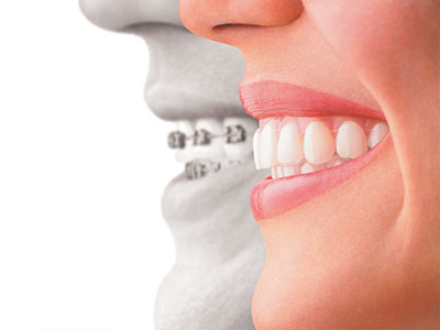 Invisalign 11772