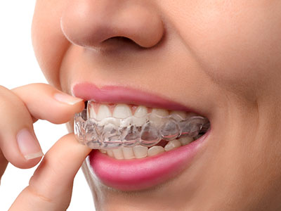 Invisalign Dentist Patchogue