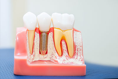 Patchogue Dental Implants