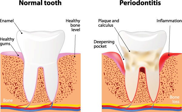 Periodontal Treatment Patchogue