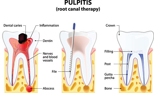 Root Canal Treatment 11772