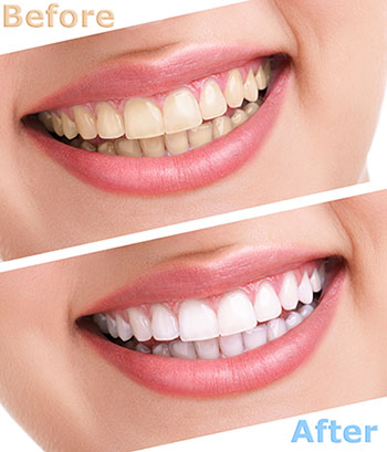 Teeth Whitening Dentist Patchogue